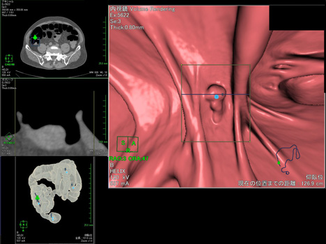 腸ポリープの大腸仮想内視鏡CT画像