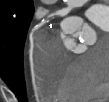 狭心症の冠動脈CT画像