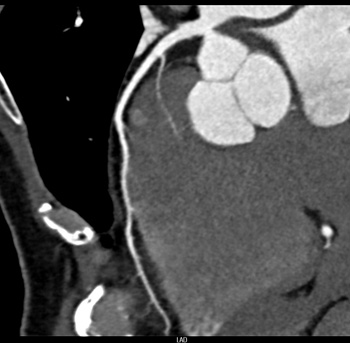 正常の冠動脈CT画像