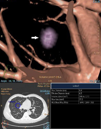 小型肺がんのCT画像